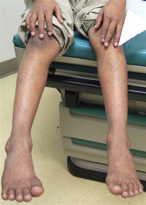 Epidermolysis Bullosa Simplex With Mottled Pigmentation