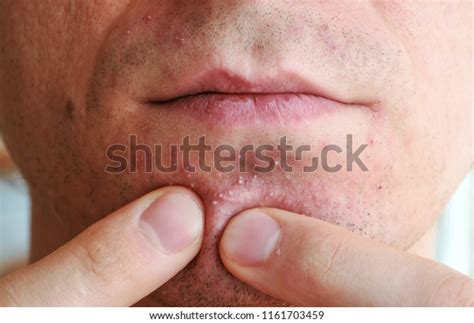 Skin Irritation After Shaving Mans Hands Stock Photo 1161703459