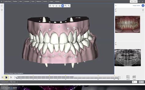 This Suresmile Aligner Software Simulation Shows Tooth Movement Over