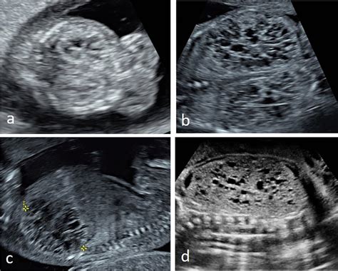 Prenatal Ultrasound Of Typical Polycystic And Dysplastic Kidneys In Two