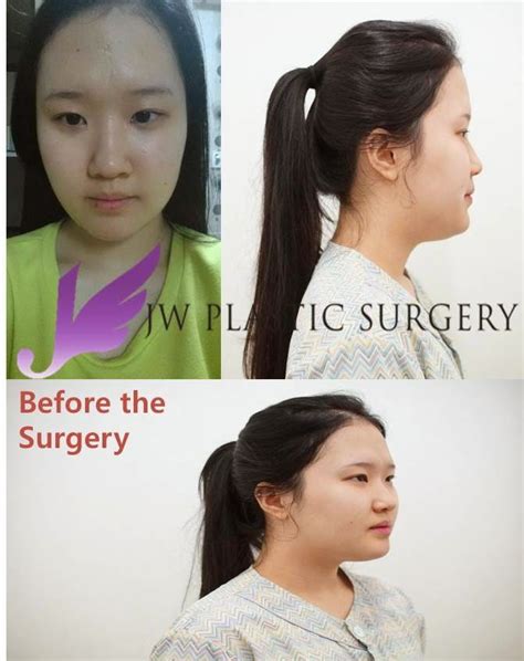 Real Story Revision For Ptosis Correction Double Eyelid Incision