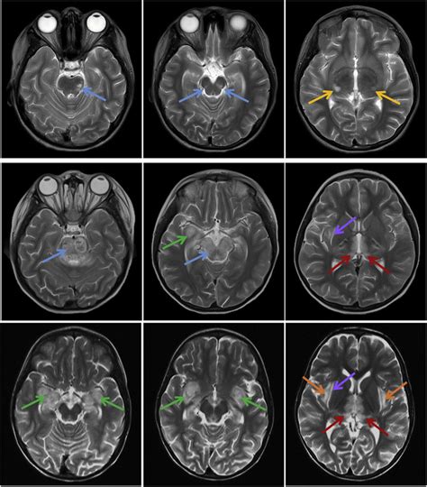 Brain Mri Findings In The Three Siblings T Weighted Images Obtained