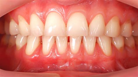 Receding Gums Causes Prevention And Treatments Dr Karen Kang Dds