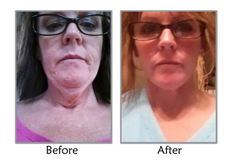 Before And After Weight Loss Neck Before And After Weight Loss