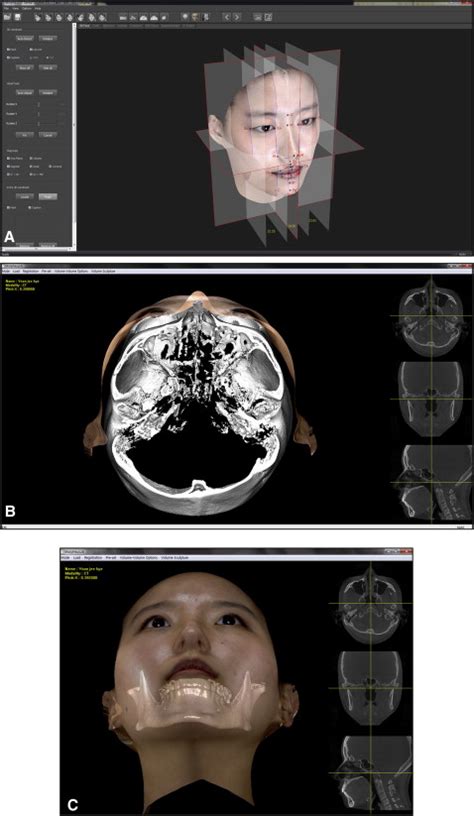 Accurate Registration Of Cone Beam Computed Tomography Scans To 3