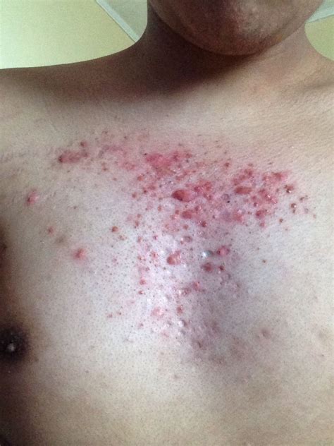 Please Help Me Treat My Severe Chest Acne General Acne Discussion Forum