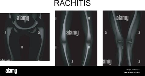 Rickets X Ray Stock Vector Images Alamy