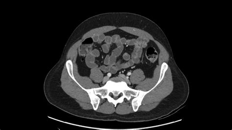 How To Read A Ct Of The Abdomen And Pelvis A Quick Pr Vrogue Co