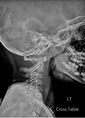 Cureus | Purely Ligamentous Flexion-Distraction Injury in a Five-Year ...