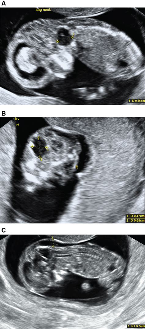Trisomy 9 Presenting In The First Trimester As A Fetal Lateral Neck