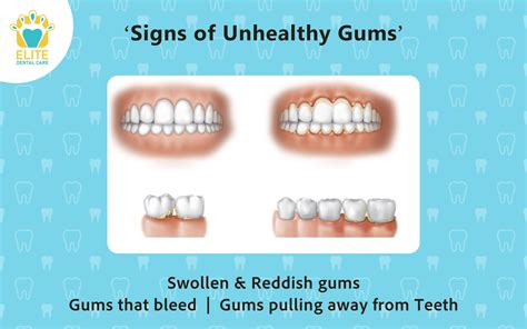Signs Of Unhealthy Gums Elite Dental Care
