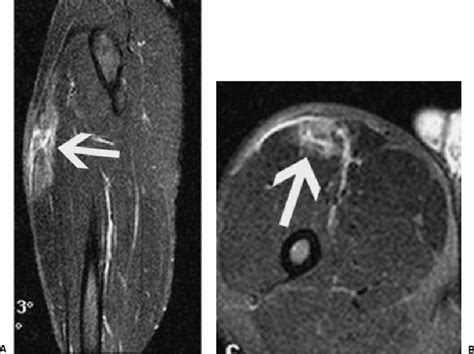 A Sagittal And B Axial Fat Suppressed T2 Weighted Images Show A