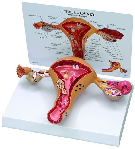 Uterus And Ovary Anatomy Model With Pathologies Uterus Anatomy