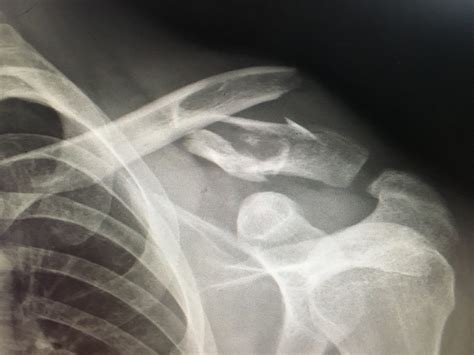 Surgical Treatment Of Mountain Biking Clavicle Fracture Jr Rudzki Md
