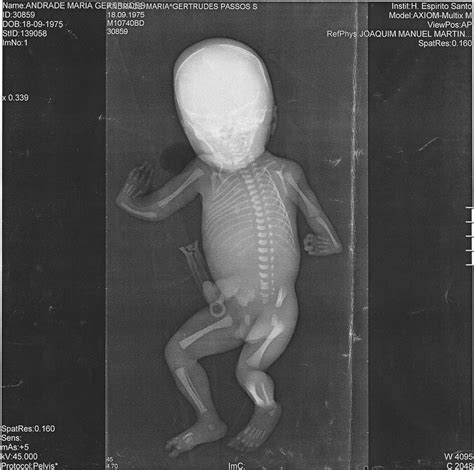 Thrombocytopenia And Absent Radius Tar Syndrome In Pregnancy Bmj