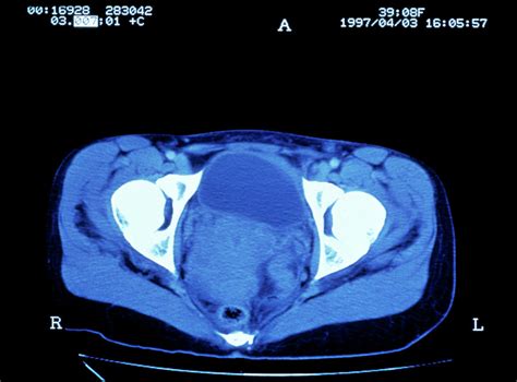 Cervical Cancer Ct Scan Photograph By Science Photo Library Pixels Merch