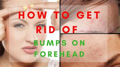 Get Rid Of Bumps Forehead Get Rid Of Bumps