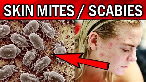 8 Effective Remedies To Get Rid Of Skin Mitesscabies Naturally Youtube
