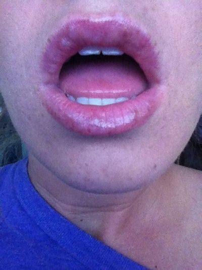 White Ish Bumps 7 Days Post Juvederm In Lips Doctor Answers Tips