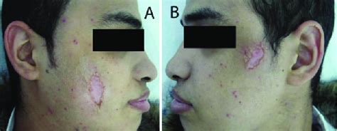 A Improvement Of The Skin Ulcer In The Right Cheek 2 Weeks After