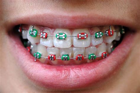 What To Do When Your Braces Wire Breaks Central Coast Orthodontics