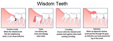 How Do Dentists Remove Impacted Wisdom Teeth Teethwalls