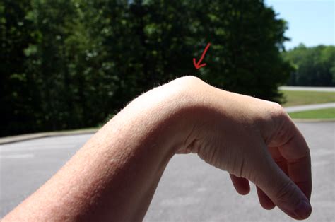 Ganglion Cysts What You Need To Know Fun Times Guide To Healthy Living
