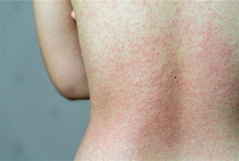 How May Coronavirus Symptoms Covid Manifest On The Skin Online Ai Dermatologist