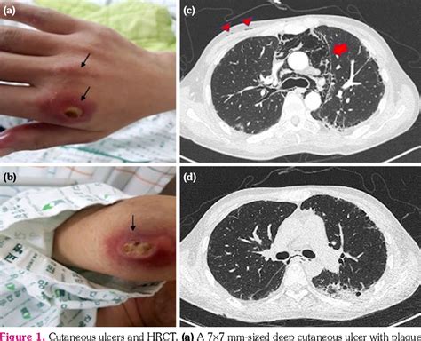 Figure From Spontaneous Pneumomediastinum And Cutaneous Ulcers Complicated In A Patient With