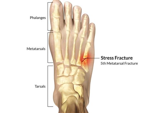 Stress Fracture Runners Tribe