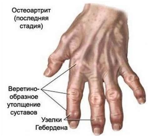 Шишки на суставах пальцев рук причины симптомы и лечение Школа красоты