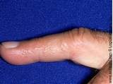 Fingernail Eczema Treatment Images