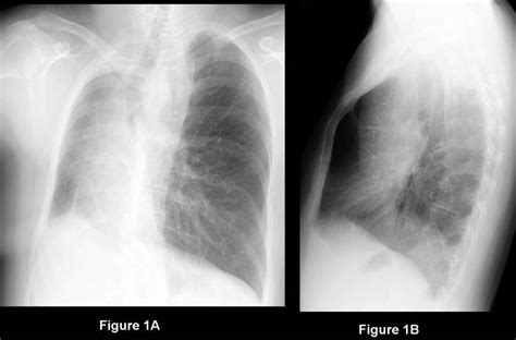 Medical State Of Mind — Unilateral Right Pulmonary Artery Agenesis With