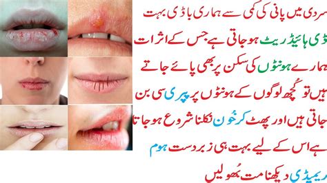 How To Get Rid Of Chapped Lips Overnight Youtube