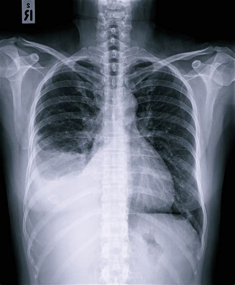 água Na Pleura Em Idosos