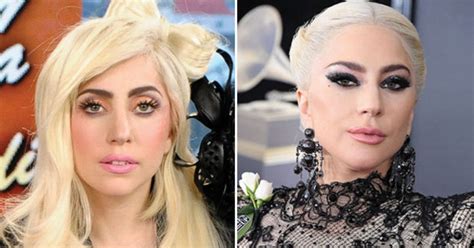 What Has Lady Gaga Done To Her Face Plastic Surgeon Dishes Dirt On
