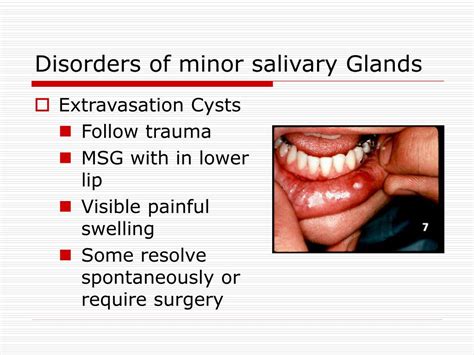 Ppt Salivary Glands Disorders Powerpoint Presentation Free Download