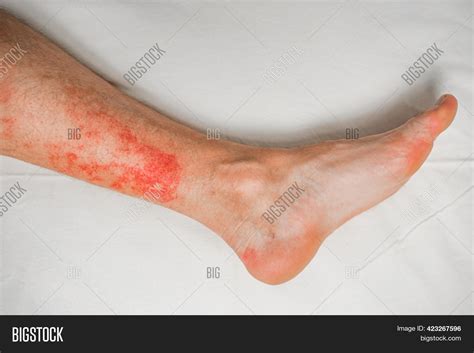 Disease Skin On Legs Image And Photo Free Trial Bigstock