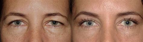Brow Lift With Upper And Lower Blepharoplasty Dr Guy Massry