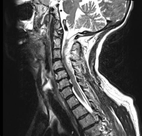 Pdf Acute Cervical Spinal Epidural Hematoma A Rare Complication Of