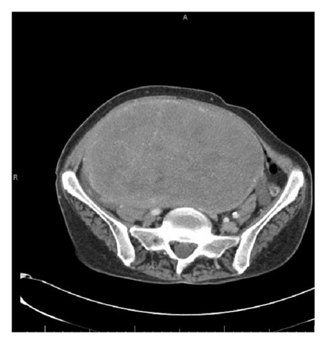 Uterus Ct Scan