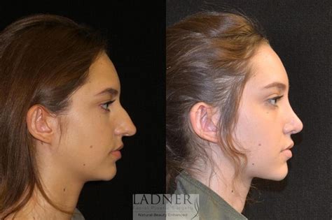 Rhinoplasty Nose Job Before And After Pictures Case 19 Denver Co Ladner Facial Plastic