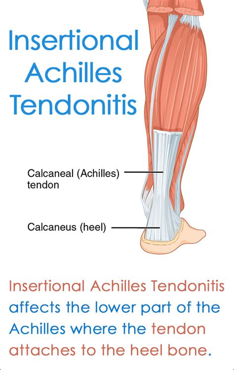 ☮ Insertional Achilles Tendinitis ⋆ Santa Barbara Deep Tissue Riktr Pro Massage Nicola Lmt