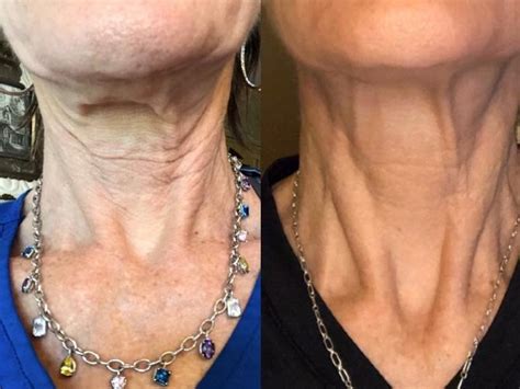 Rf Microneedling Neck And Chest Smooth Synergy Medical Spa And Laser Center