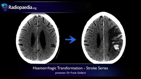 Stroke Haemorrhagic Transformation Radiology Video Tutorial Ct Mri