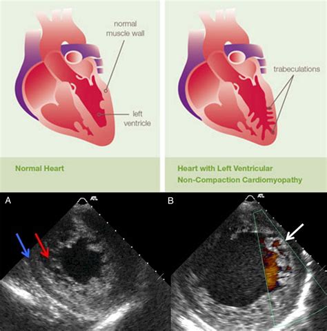Left Ventricular Non Compaction Cardiomyopathy First Grepmed