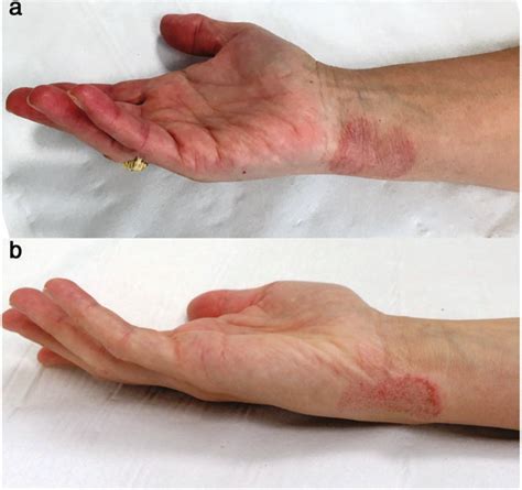 Occupational Allergic Contact Dermatitis Caused By Isothiazolinones In
