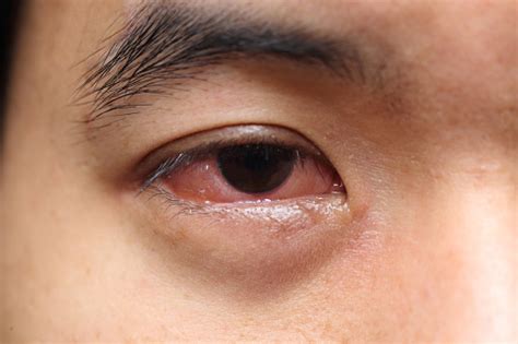 What Causes Mucus In Eye Eye Discharge And How To Get Rid Of It