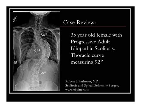 Case Review 41 35 Year Old Female With A 92 Degree Scoliosis