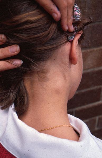 Swollen Bump Behind Ear Lobe Causes Swollen Lymph Nodes Lymph Nodes